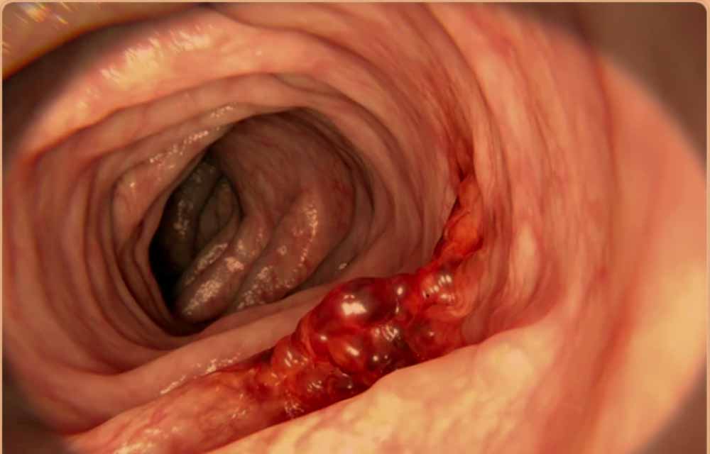 colon cancer